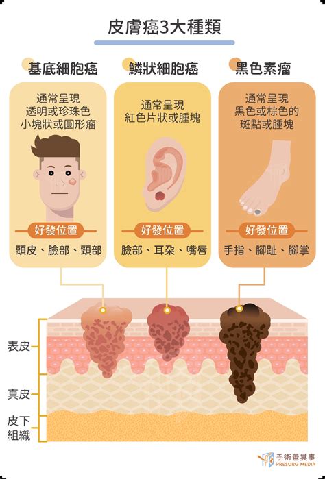 皮膚癌|皮膚癌分期治療方式？皮膚癌照片、治療費用、治癒率一次看